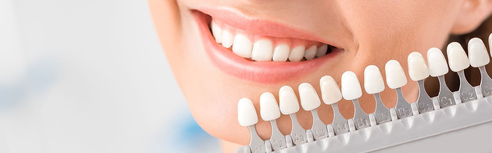 Waarom kiezen steeds meer mensen voor facings als esthetische tandheelkundige oplossing?